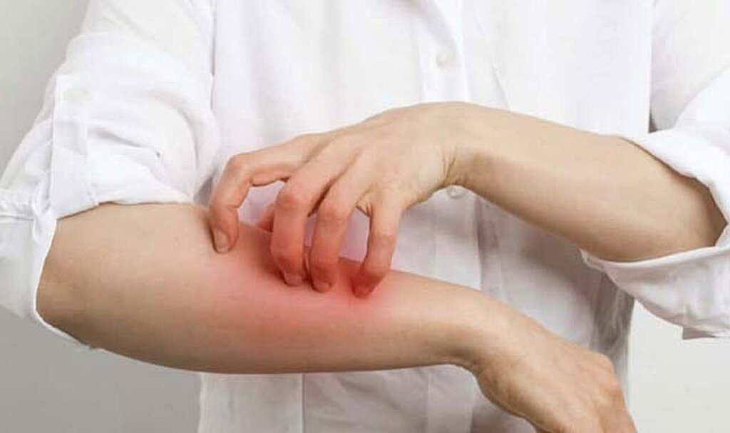 Uyuz Hastalığı neden olur? Uyuz hastalığı belirtileri ve tedavisi