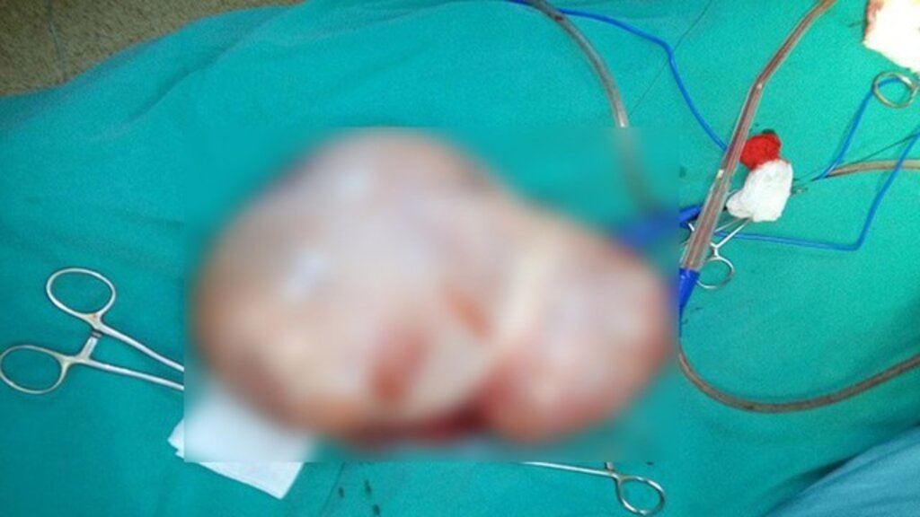 Samsun'da kadın hastanın karnından 5 kilo 350 gram ağırlığında kist çıktı